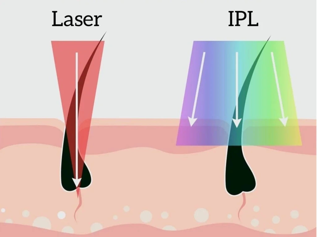 IPL vs Láser: ¿Cuál es Mejor para Eliminar el Vello?